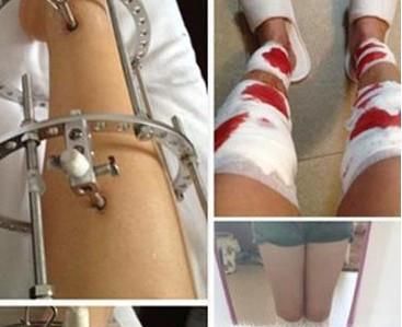 如何改善X腿型，O腿型？