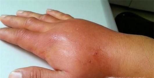 夏季被马蜂蛰了怎么办？