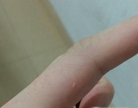 手指肚上扎了细小的刺怎么办