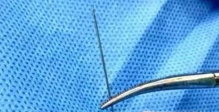 手指肚上扎了细小的刺怎么办