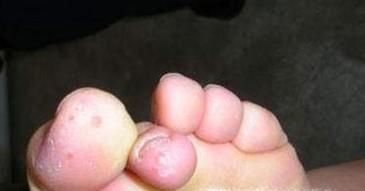 水疱型足癣用什么药？脚上长了很多小水泡痒脱皮