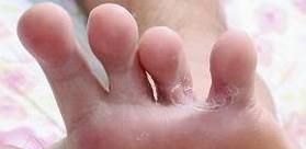 水疱型足癣用什么药？脚上长了很多小水泡痒脱皮