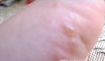 水疱型足癣用什么药？脚上长了很多小水泡痒脱皮