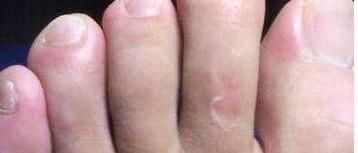水疱型足癣用什么药？脚上长了很多小水泡痒脱皮