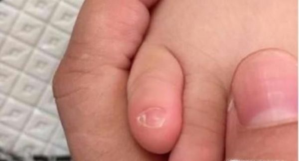 为什么很多中国人小脚趾甲是两瓣的？