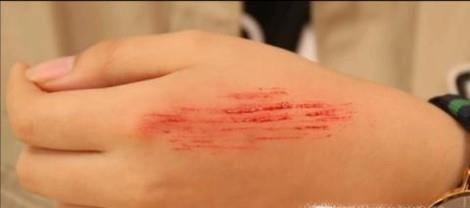 常见的运动损伤与处理