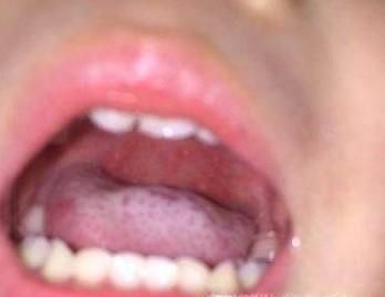 疱症性咽峡炎与手足口病之间的区别