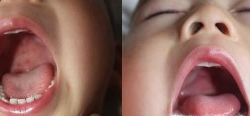 疱症性咽峡炎与手足口病之间的区别