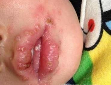 疱症性咽峡炎与手足口病之间的区别