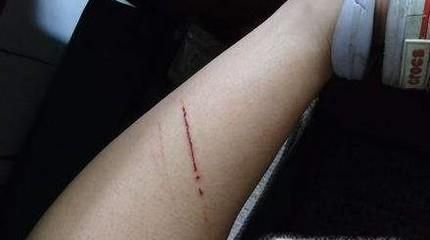 被猫咪抓伤应该怎么处理