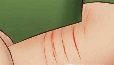 被猫咪抓伤应该怎么处理