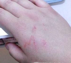 被猫咪抓伤应该怎么处理