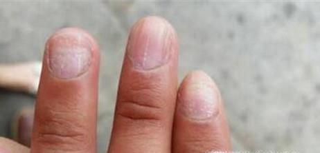 有了灰指甲,用花椒蒜醋液治好