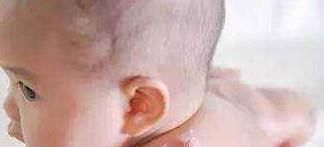 被蚊子咬后，怎样止痒快速有效？