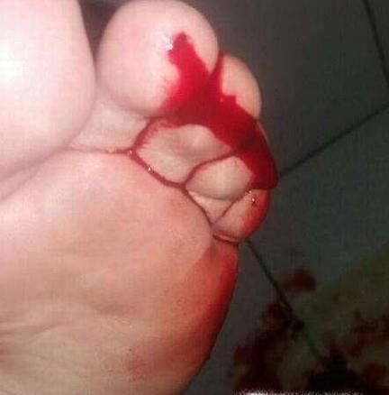 怎么判断是不是被蝙蝠咬了