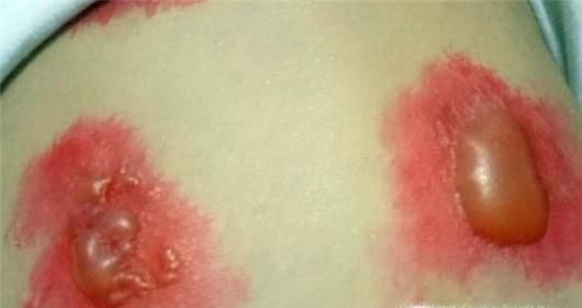 如何健康使用三伏贴？使用三伏贴注意事项！