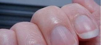 手指上的月牙痕代表什么