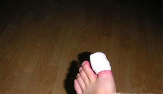 患有甲沟炎怎么办？生活中如何预防甲沟炎？