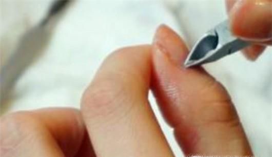 如何正确处理手上的倒刺？倒刺发炎了怎么办？