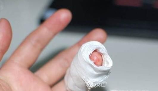 如何正确处理手上的倒刺？倒刺发炎了怎么办？