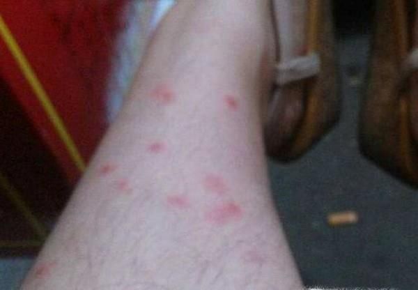 如何处理被跳蚤叮咬以及预防