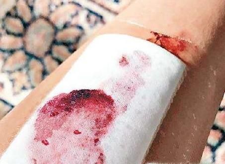 纱布和伤口粘在一起怎么办