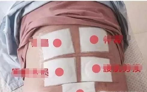 5个治疗腰间盘突出的传统方法