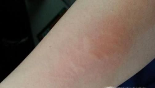 吃小龙虾有哪些注意事项？哪些人群不能吃小龙虾