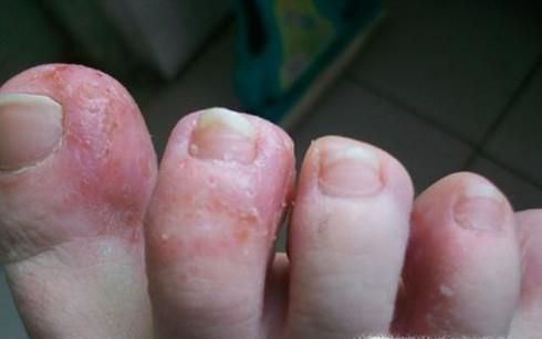 热水泡脚的6个禁忌