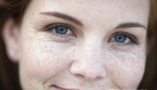 脸上长黑色素怎么办