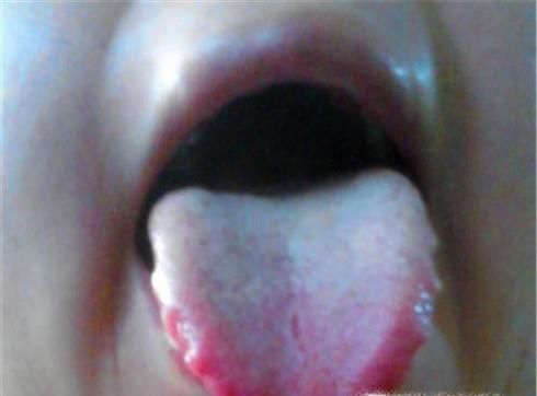 为什么舌苔会白厚？舌苔白厚是什么原因引起的