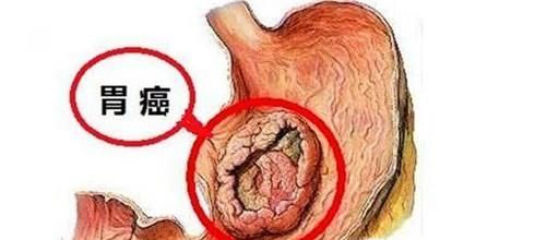 为什么舌苔会白厚？舌苔白厚是什么原因引起的