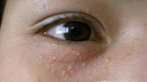 扁平疣如何彻底根除