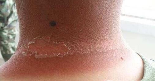 怎样迅速进行晒后修复？