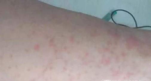 红霉素软膏有哪些非常不错的功效？