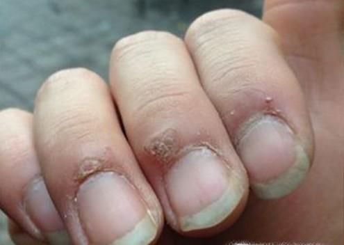 红霉素软膏有哪些非常不错的功效？
