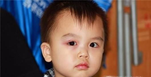 秋季如何预防孩子患上红眼病？