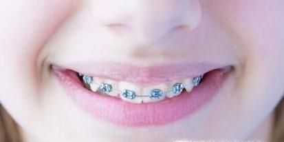 带牙套的好处和坏处有哪些