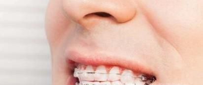 带牙套的好处和坏处有哪些