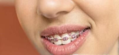 带牙套的好处和坏处有哪些