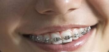 带牙套的好处和坏处有哪些