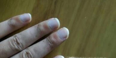 手指甲有点泛白是什么原因
