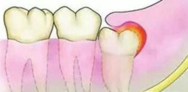 长智齿了该拔还是不该拔