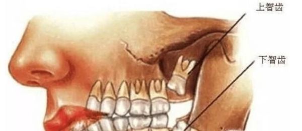 长智齿了该拔还是不该拔