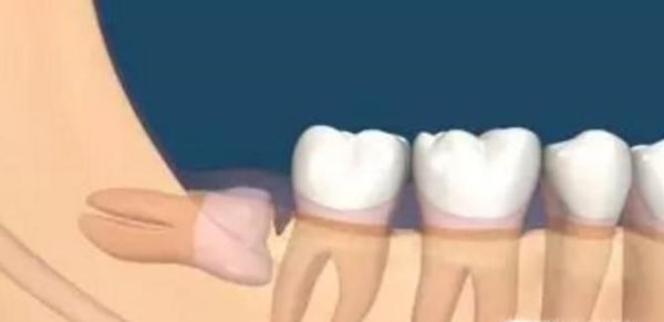 长智齿了该拔还是不该拔