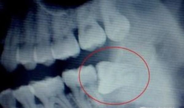 长智齿了该拔还是不该拔