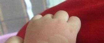 红霉素眼膏有什么作用?