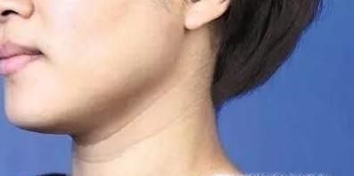 红霉素眼膏有什么作用?