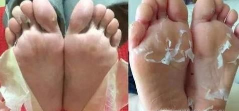怎样去除脚上的老皮？