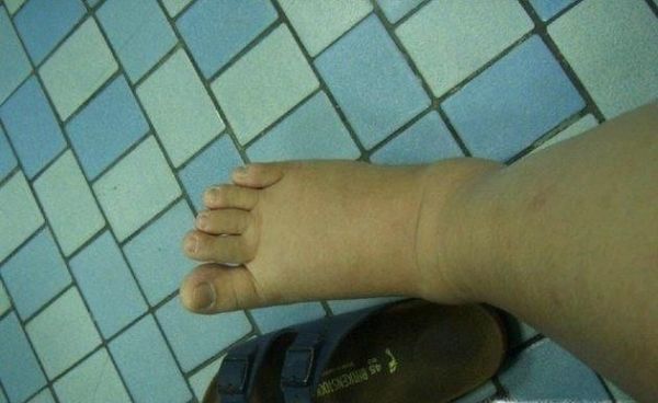 孕妇身体和脚浮肿的原因和消去浮肿的方法